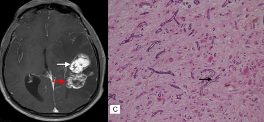 Zakażenie Aspergillus fumigatus w mózgu